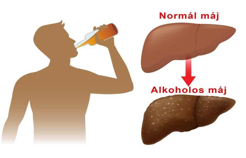 Alkoholos máj tünetei